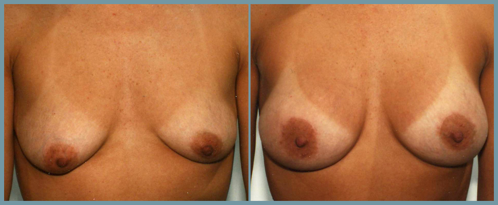 Breast Enlargement  Breast Enhancement