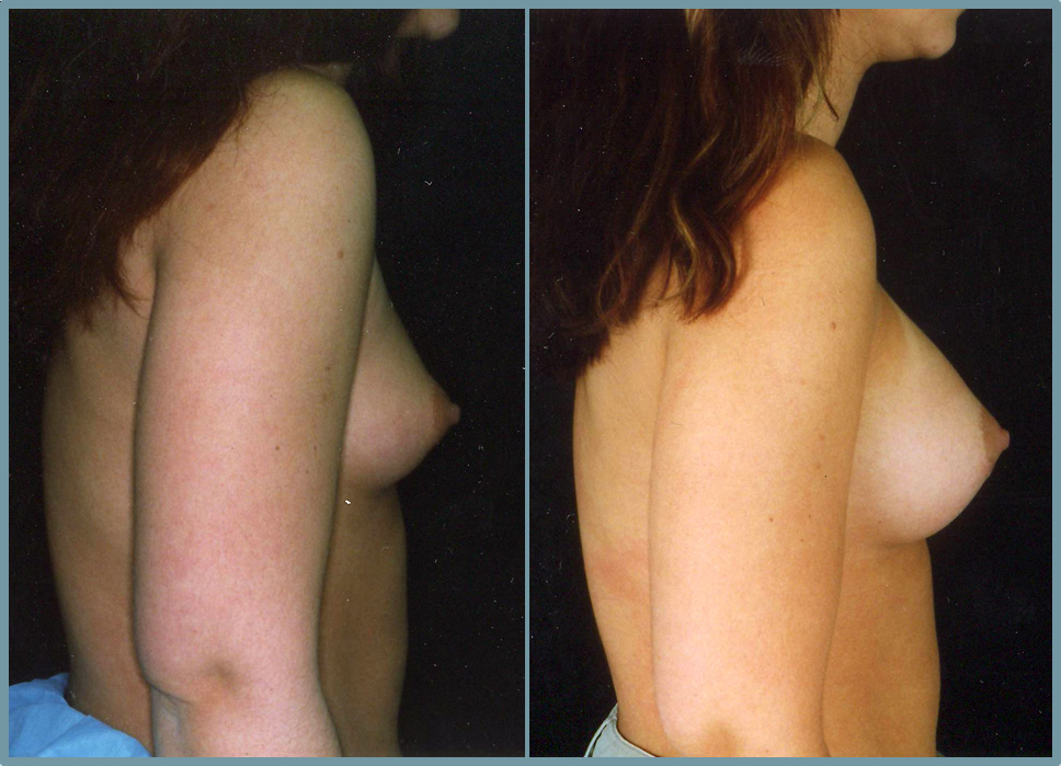 Breast Enlargement  Breast Enhancement