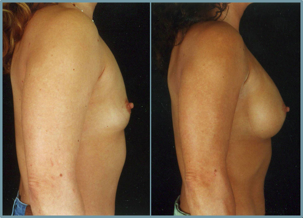 Breast Enlargement  Breast Enhancement
