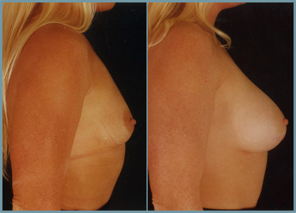 Breast Enlargement  Breast Enhancement