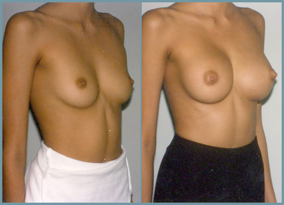 Breast Enlargement  Breast Enhancement