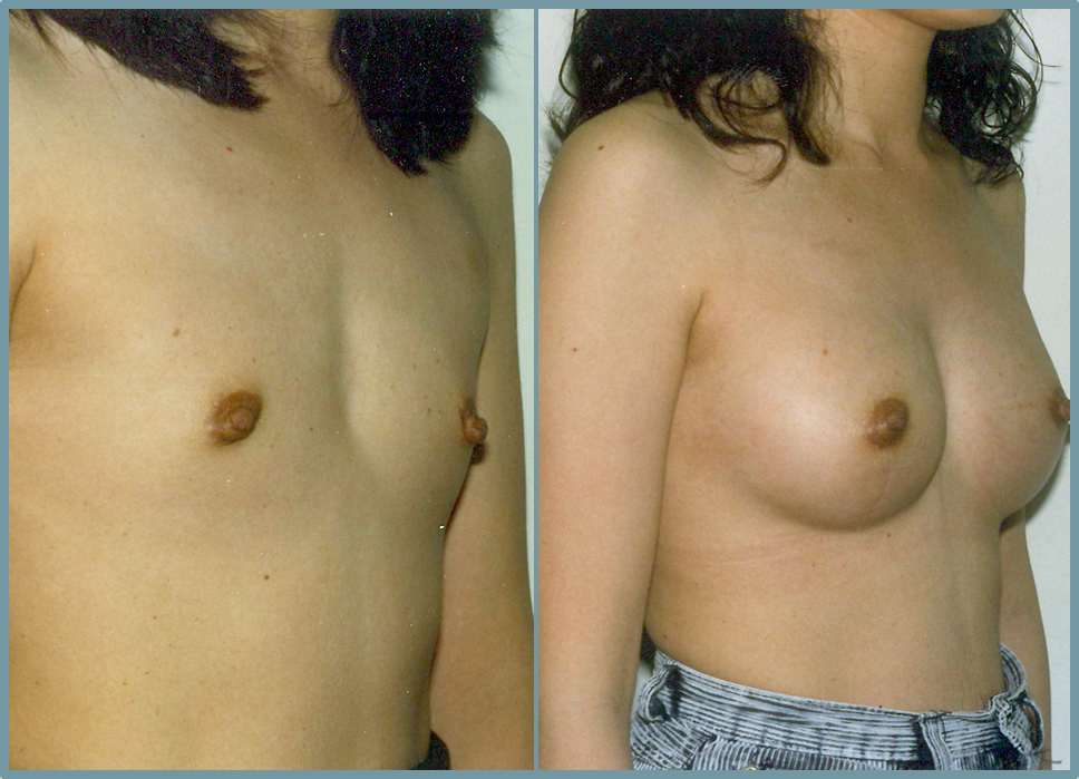 Breast Enlargement  Breast Enhancement