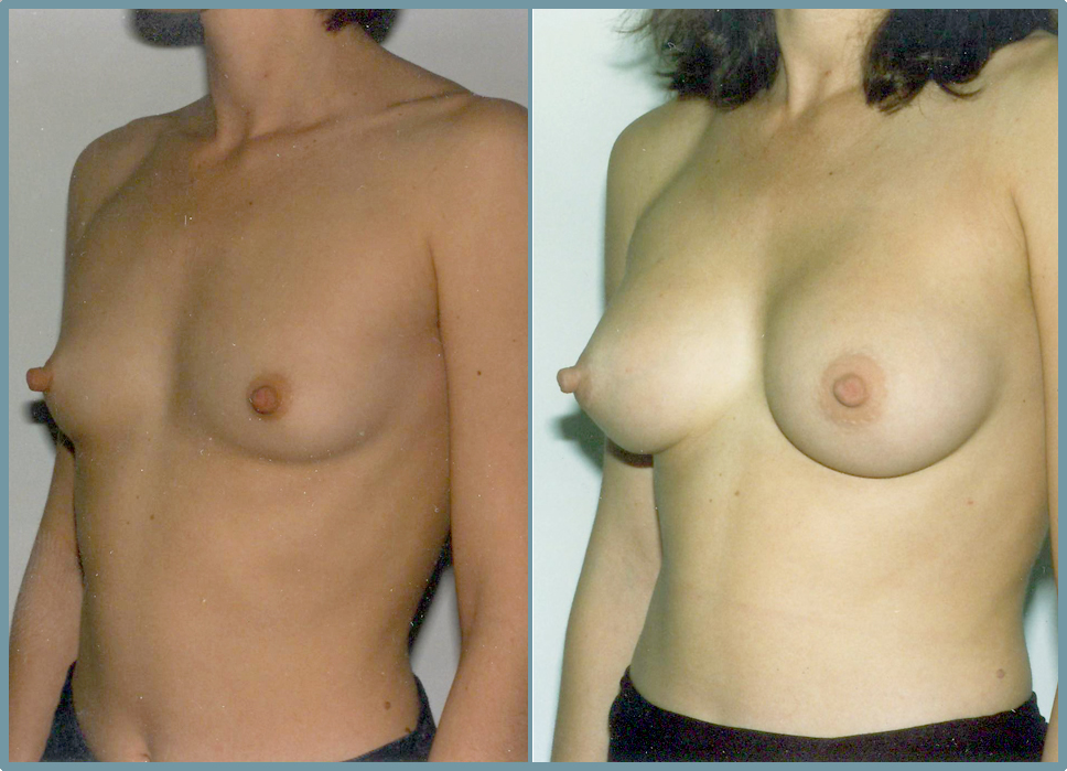 Breast Enlargement  Breast Enhancement