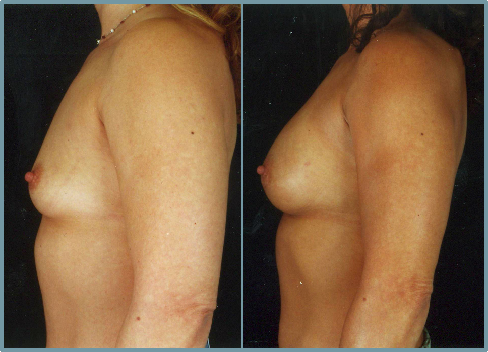 Breast Enlargement  Breast Enhancement