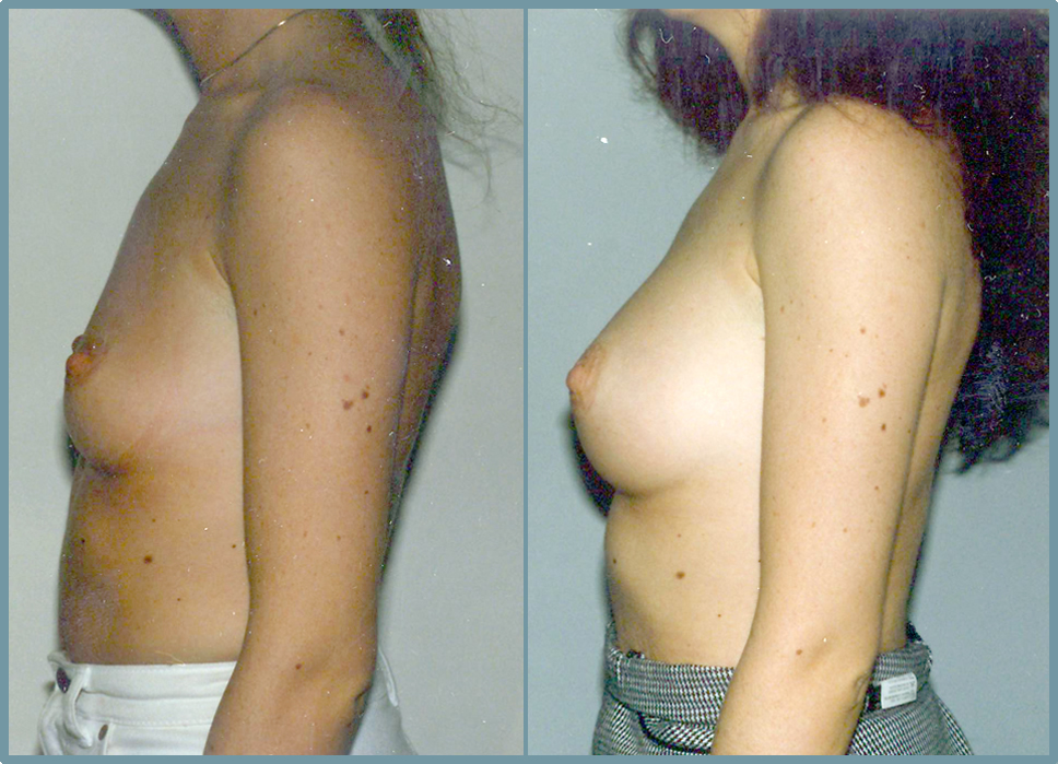Breast Enlargement  Breast Enhancement