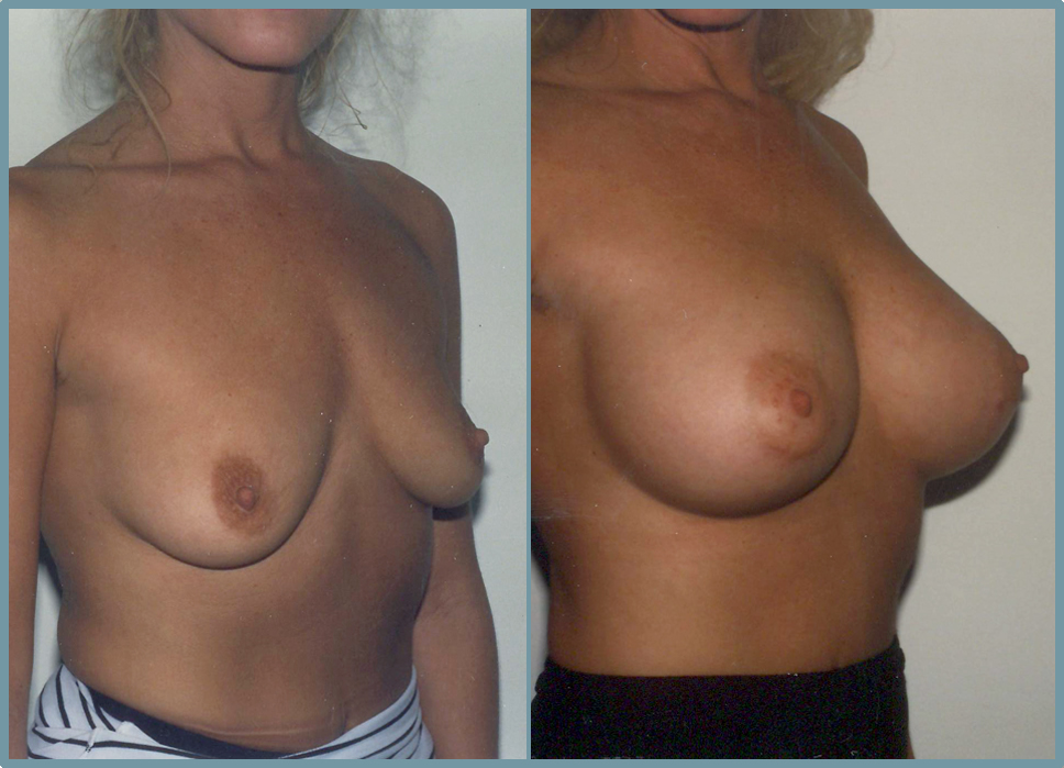 Breast Enlargement  Breast Enhancement