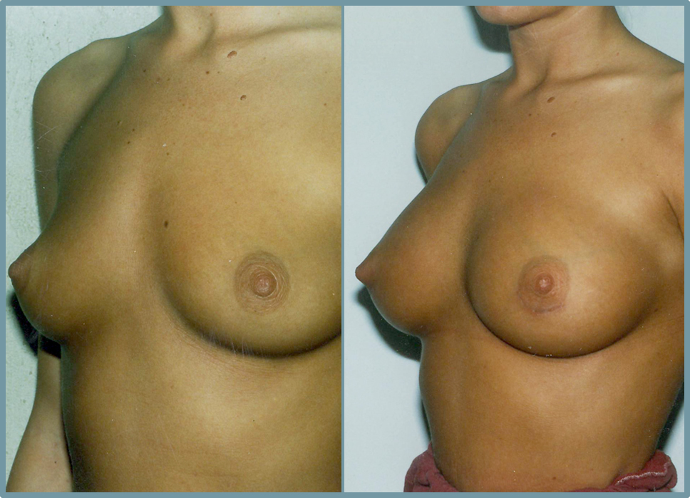 Breast Enlargement  Breast Enhancement
