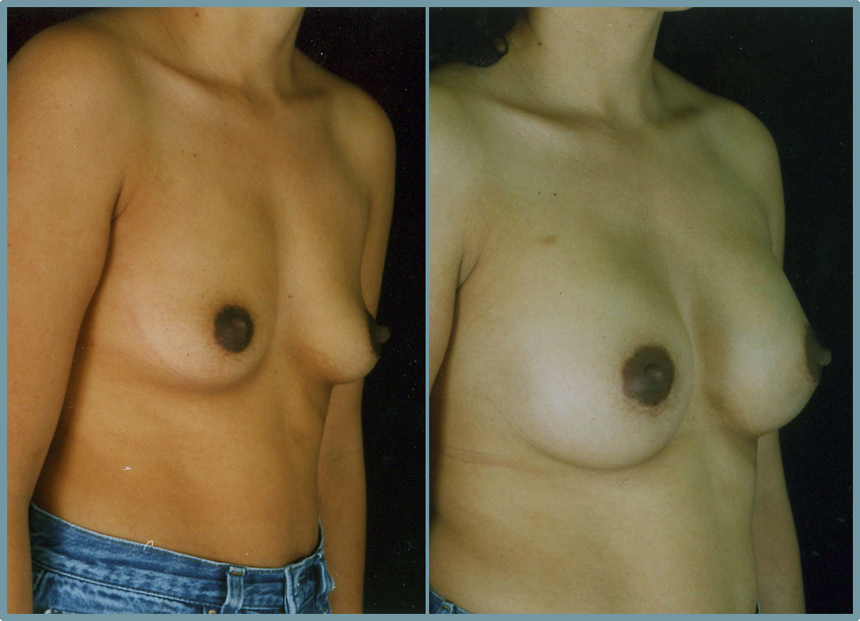 Breast Enlargement  Breast Enhancement