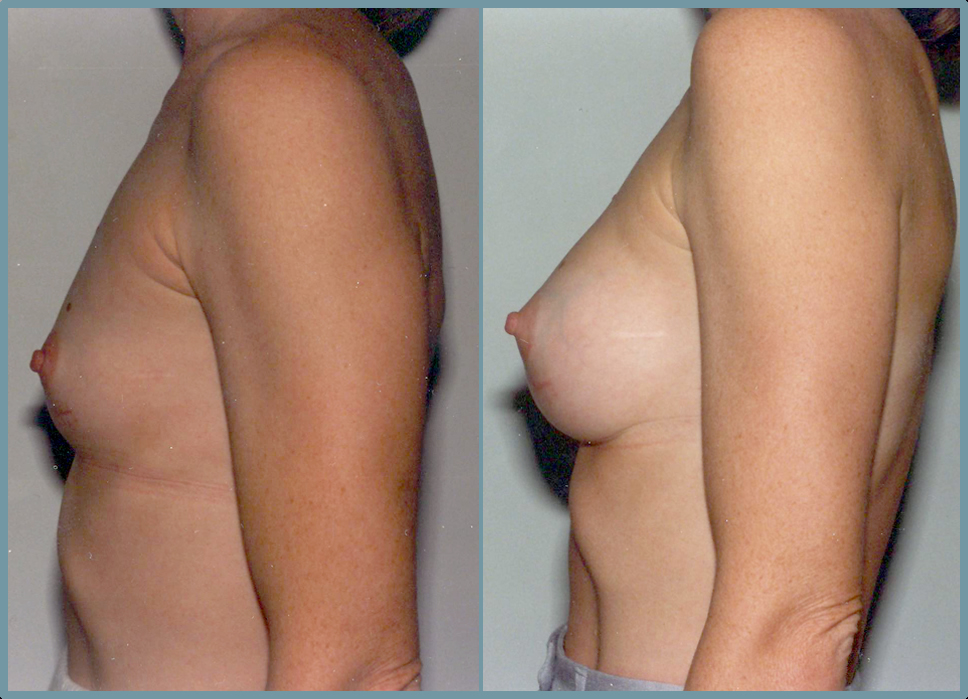 Breast Enlargement  Breast Enhancement
