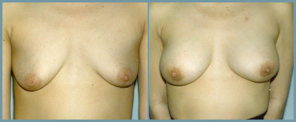 Breast Enlargement  Breast Enhancement