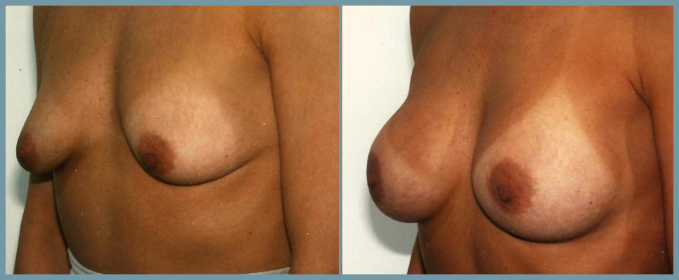 Breast Enlargement  Breast Enhancement