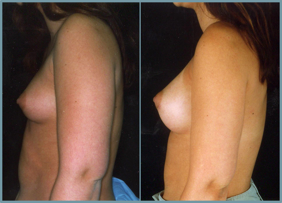 Breast Enlargement  Breast Enhancement
