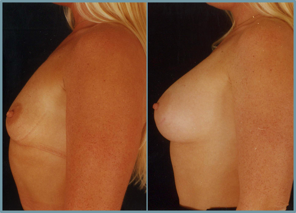 Breast Enlargement  Breast Enhancement