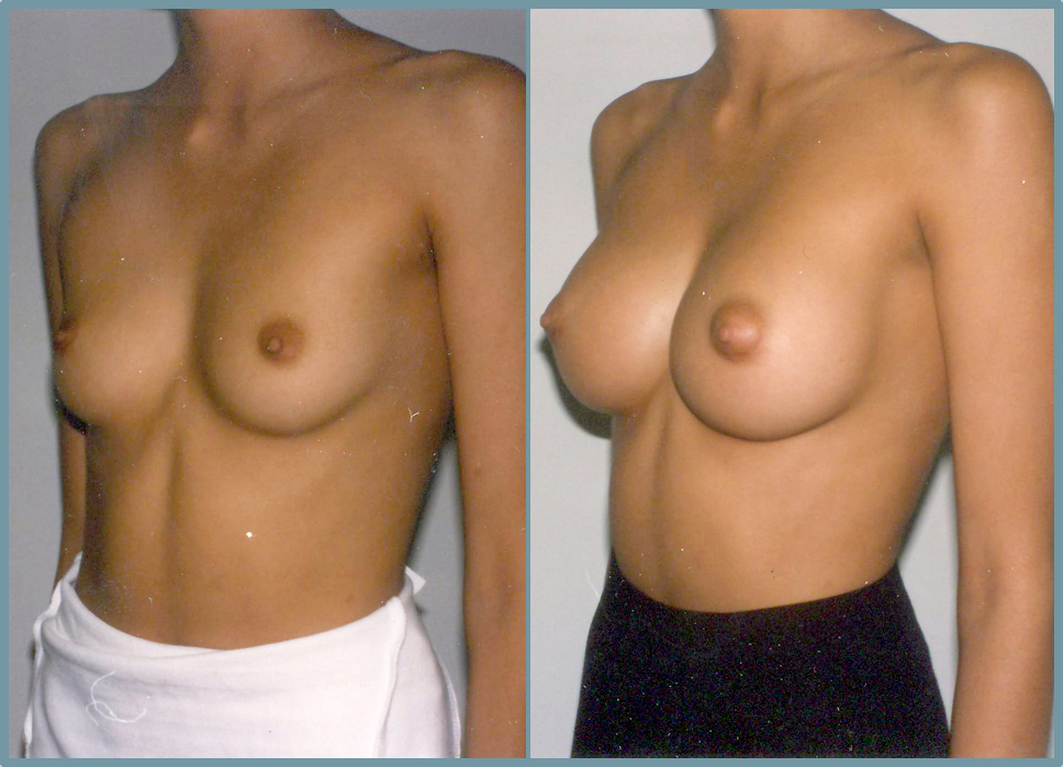 Breast Enlargement  Breast Enhancement