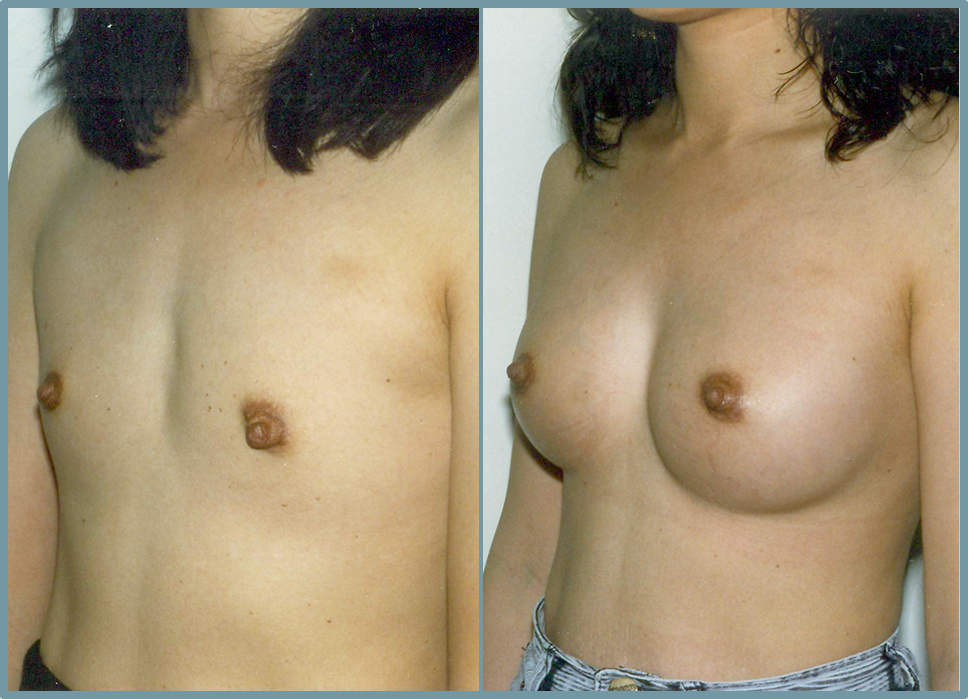Breast Enlargement  Breast Enhancement