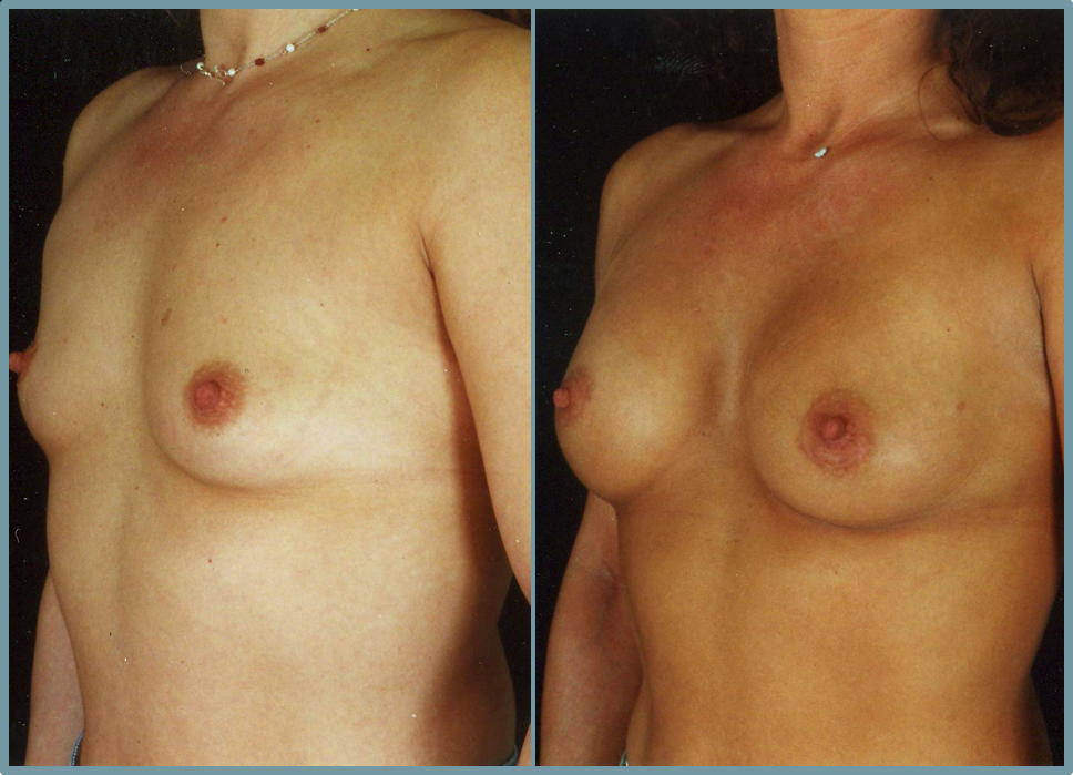 Breast Enlargement  Breast Enhancement
