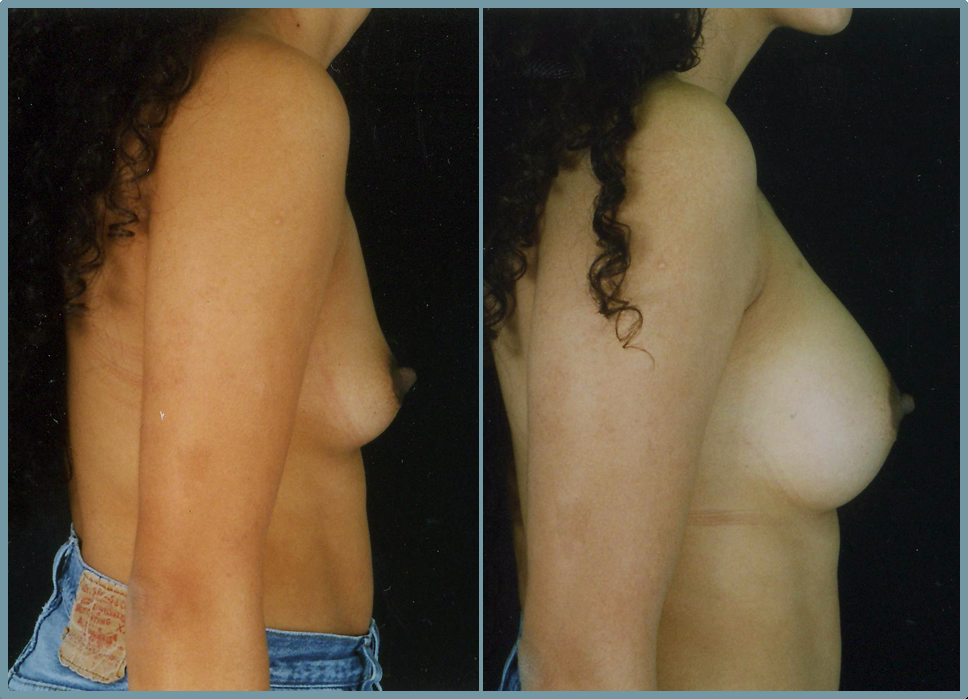 Breast Enlargement  Breast Enhancement