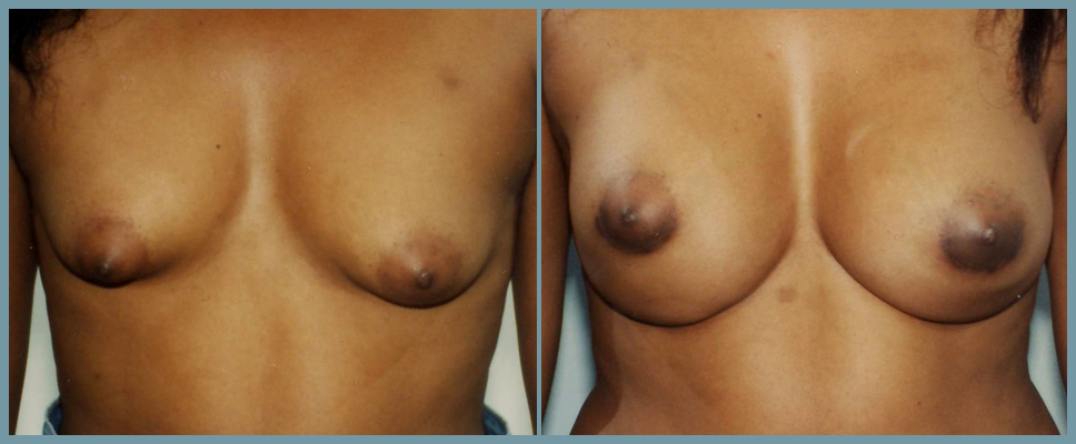 Breast Enlargement  Breast Enhancement
