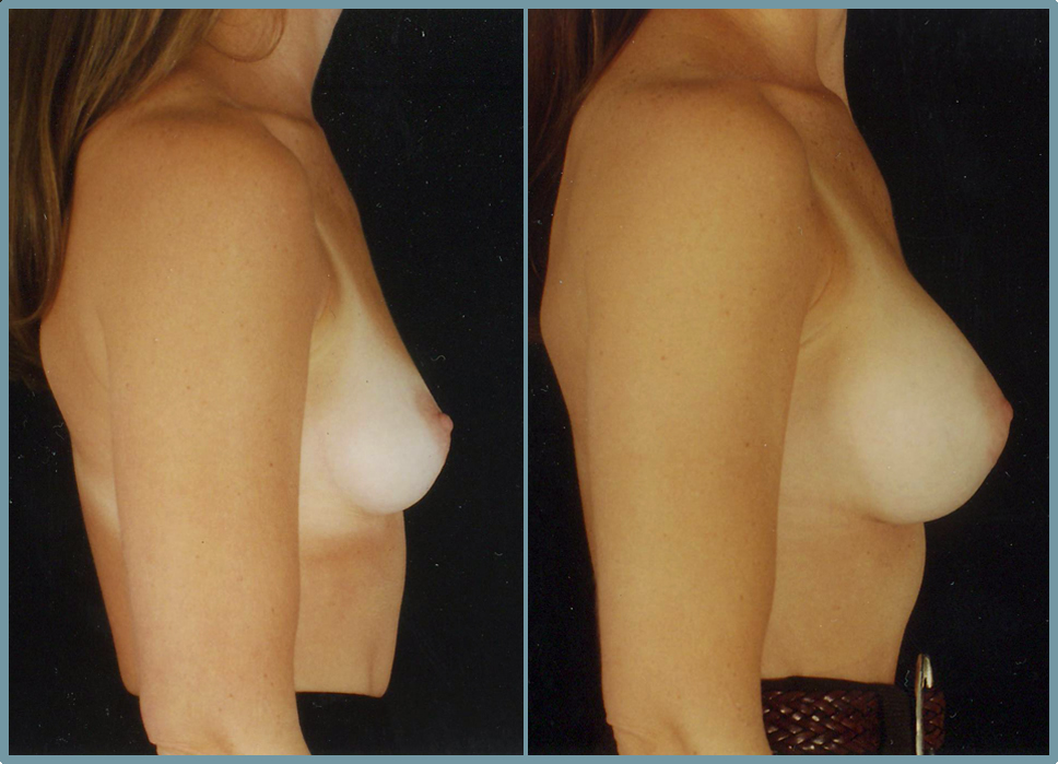 Breast Enlargement  Breast Enhancement