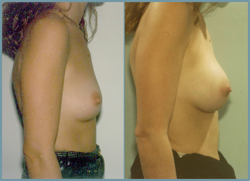 Breast Enlargement  Breast Enhancement