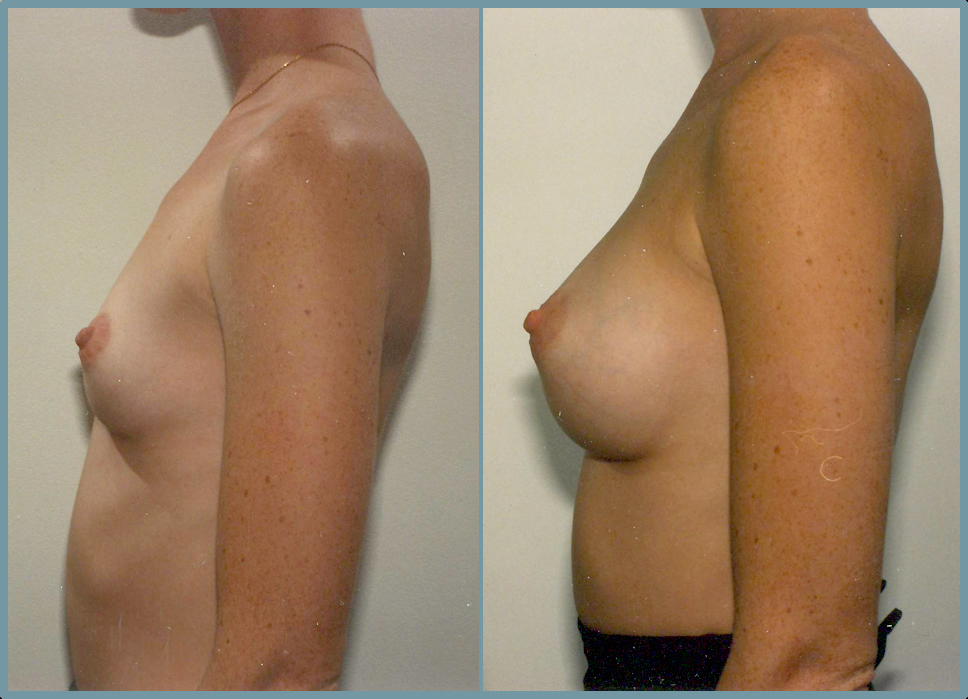 Breast Enlargement  Breast Enhancement