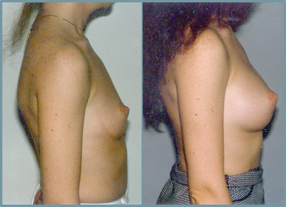 Breast Enlargement  Breast Enhancement