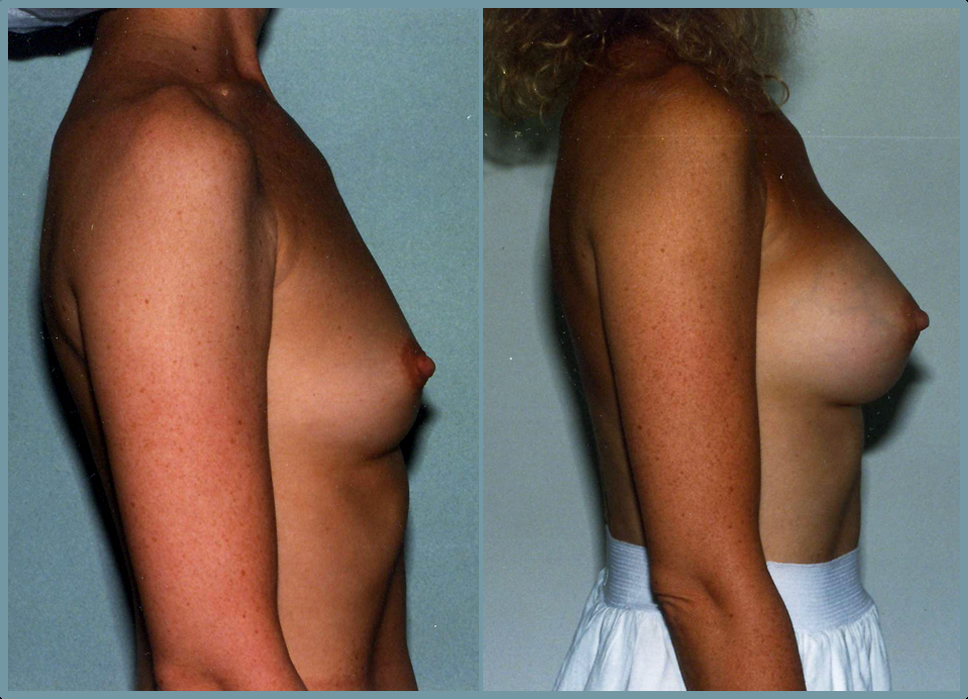 Breast Enlargement  Breast Enhancement