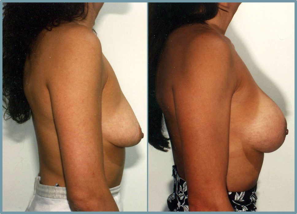 Breast Enlargement  Breast Enhancement