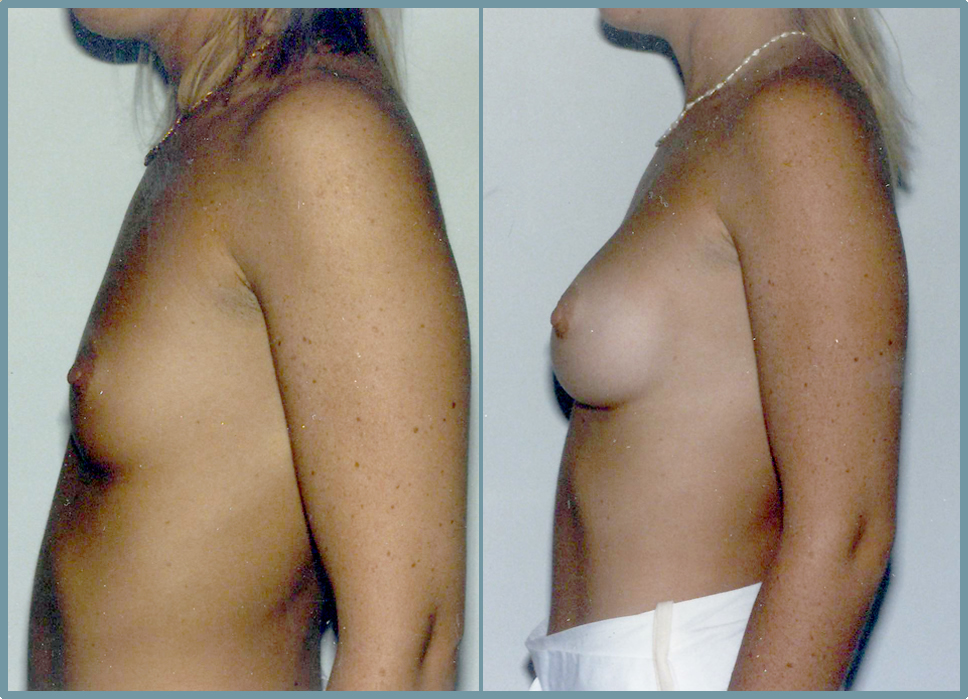Breast Enlargement  Breast Enhancement