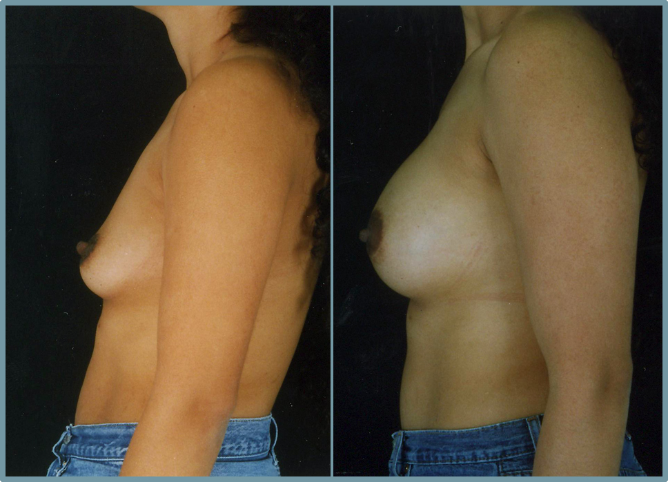Breast Enlargement  Breast Enhancement