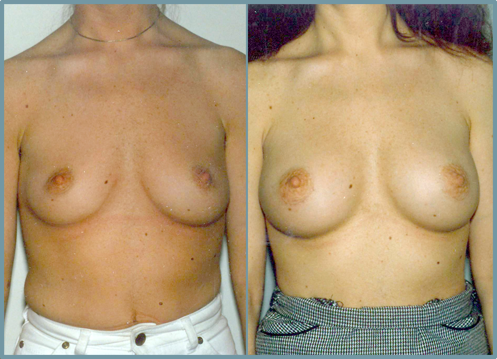 Breast Enlargement  Breast Enhancement