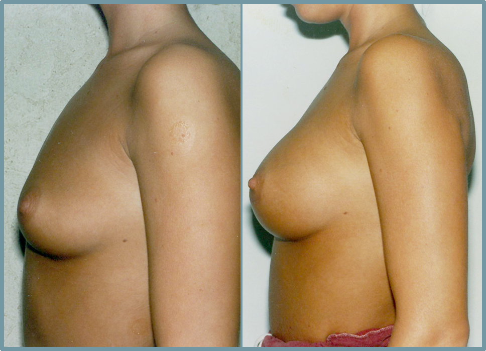 Breast Enlargement  Breast Enhancement