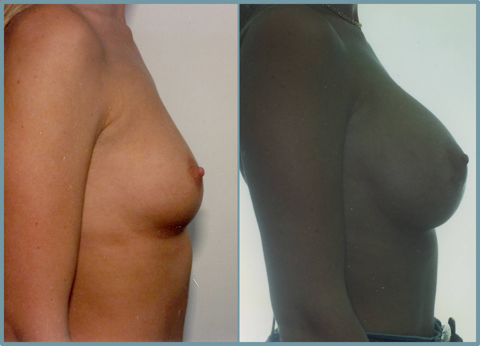 Breast Enlargement  Breast Enhancement