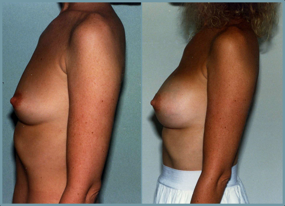 Breast Enlargement  Breast Enhancement