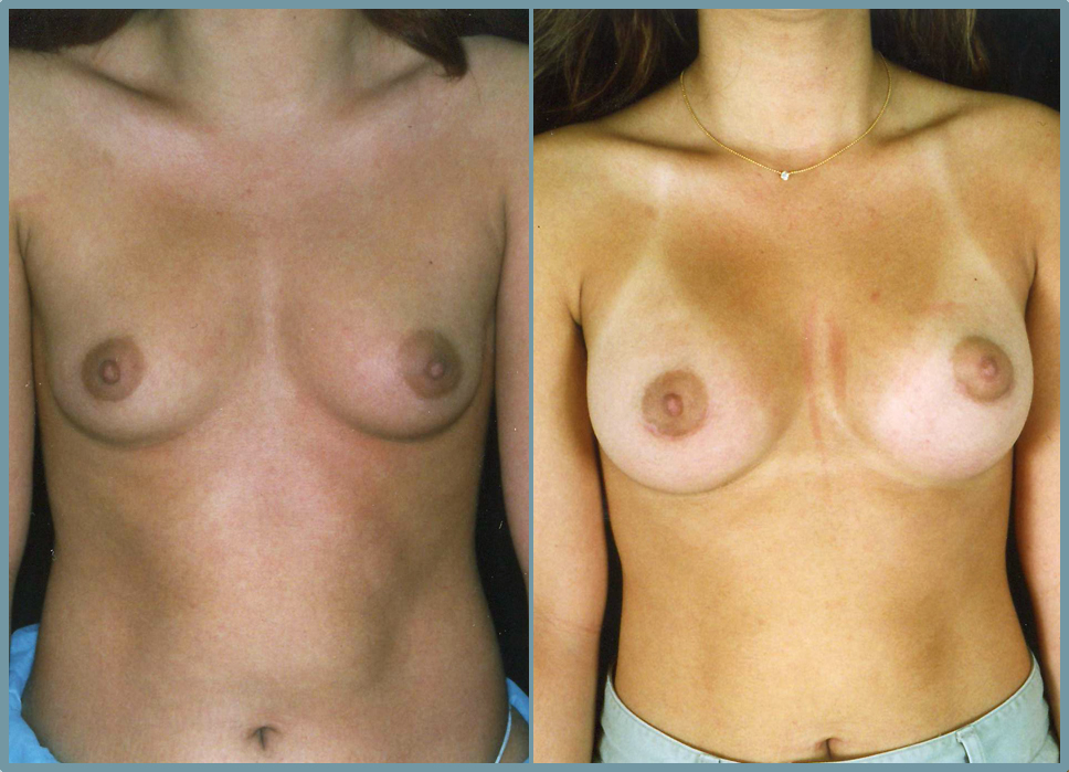 Breast Enlargement  Breast Enhancement