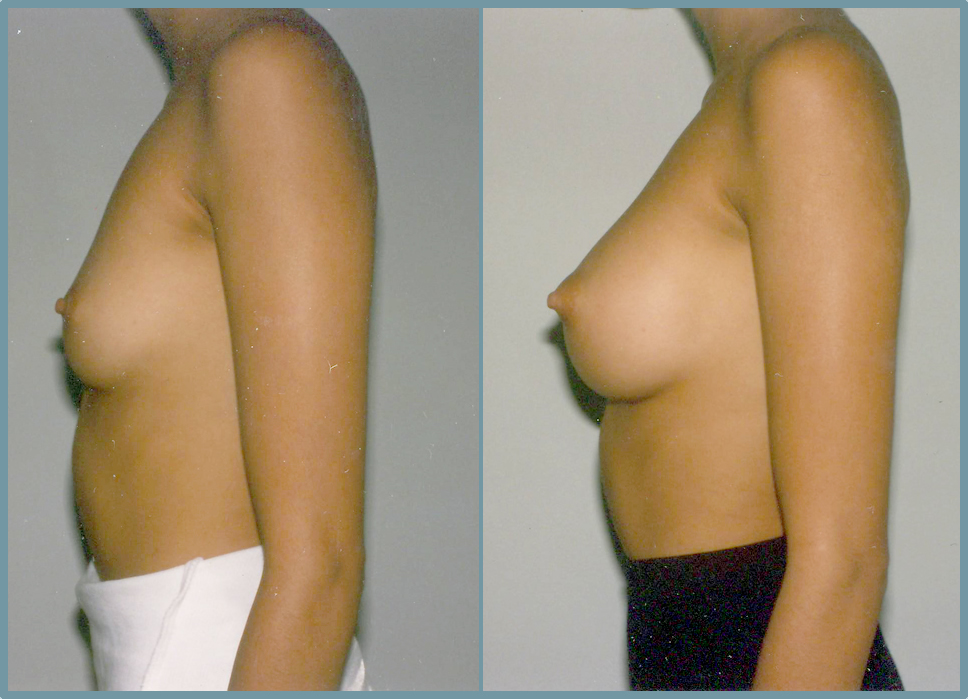 Breast Enlargement  Breast Enhancement