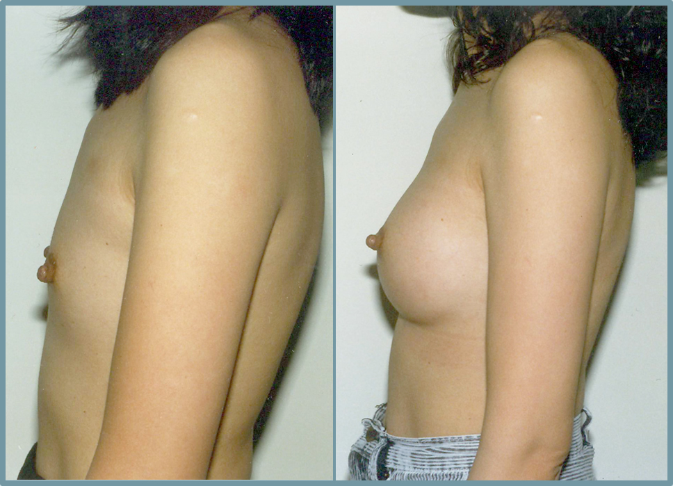 Breast Enlargement  Breast Enhancement