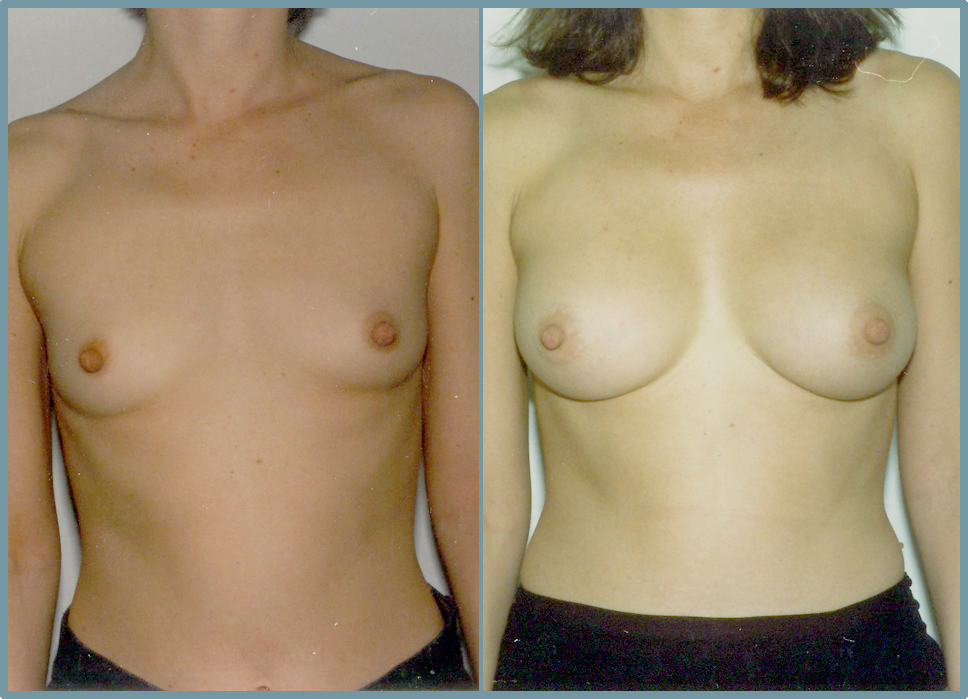 Breast Enlargement  Breast Enhancement