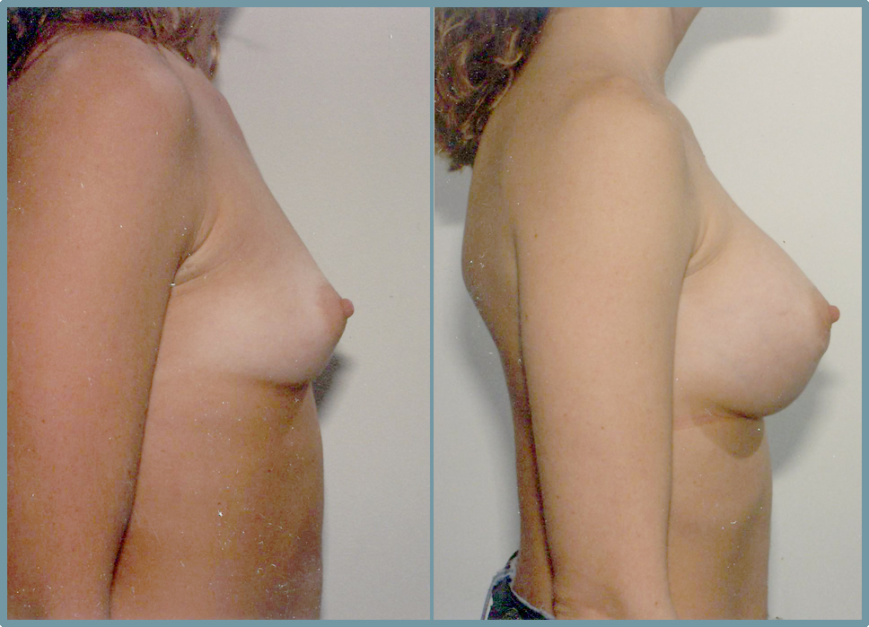 Breast Enlargement  Breast Enhancement