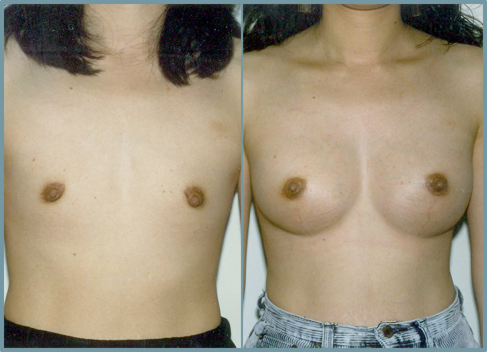Breast Enlargement  Breast Enhancement