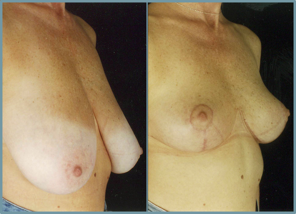 Breast Reduction