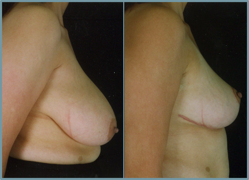 Breast Reduction