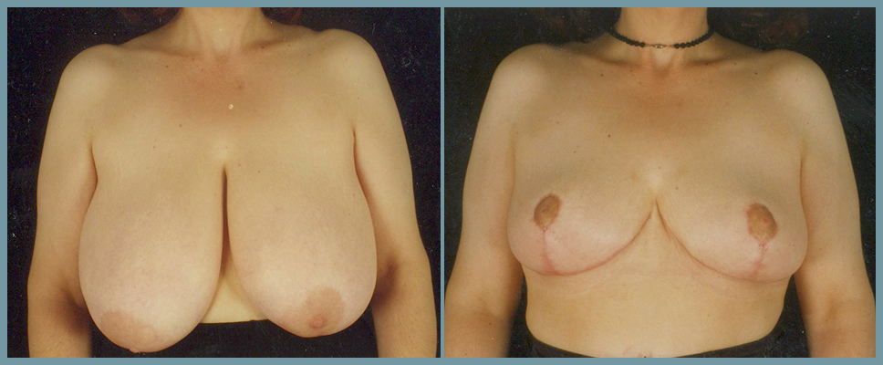 Breast Reduction
