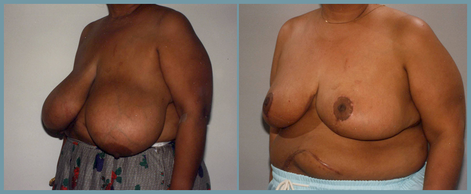 Breast Reduction
