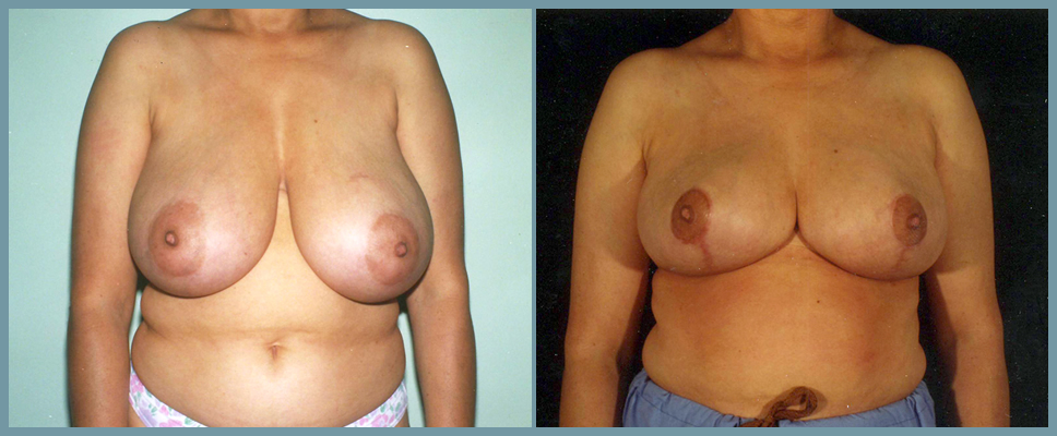 Breast Reduction