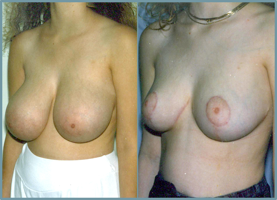 Breast Reduction