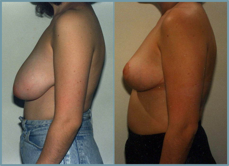 Breast Reduction