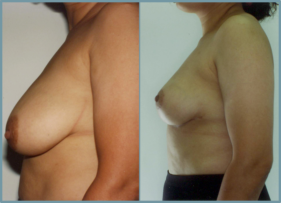 Breast Reduction