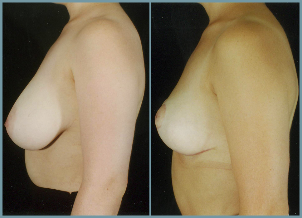 Breast Reduction