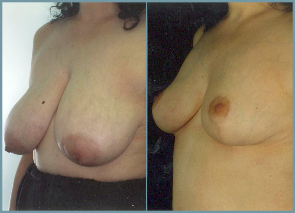 Breast Reduction